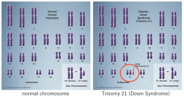 Normal chromosomes on the left, trisomy 21 (Down syndrome) on the right.