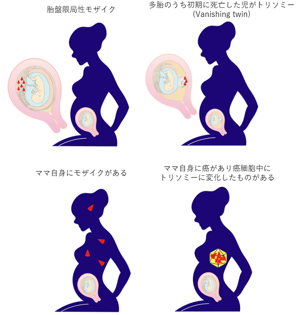 左から胎盤限局性モザイク、多胎のうち初期に死亡した児がトリソミー(Vanishing twin)、ママ自身にモザイクがある、ママ自身に癌があり癌細胞中にトリソミーに変化したものがある