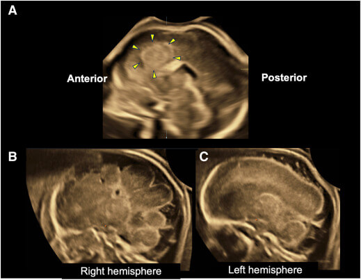 受精後に一部の組織だけに生じた遺伝子変化